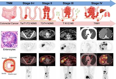 Tailoring the clinical management of colorectal cancer by 18F-FDG PET/CT